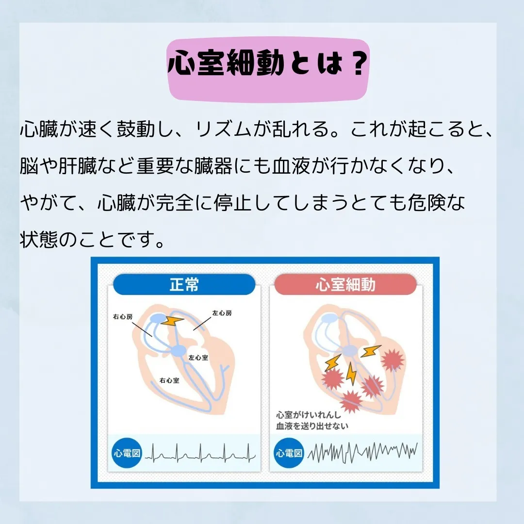 🚑知っておきたい心室細動の知識