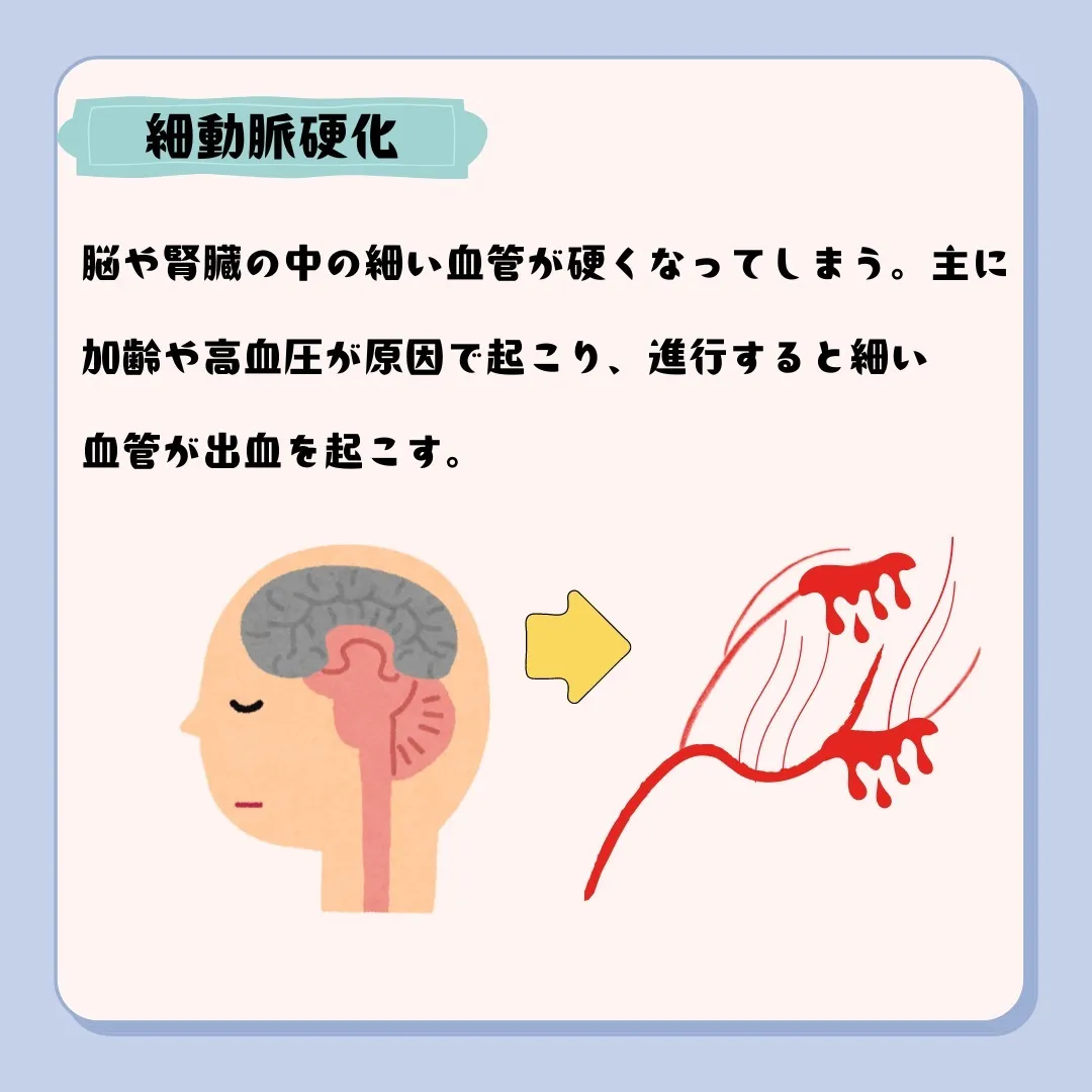 📌動脈硬化の種類と特徴