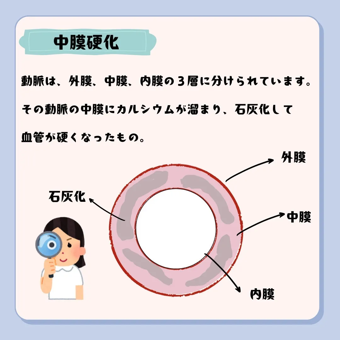 📌動脈硬化の種類と特徴